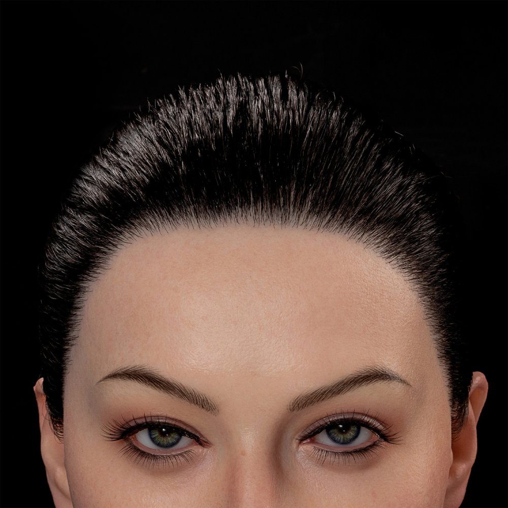 Implanted hairline example